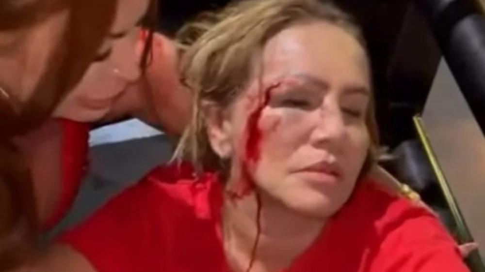 Vereadora Iara Pimentel foi atingida no rosto durante ataque a carro de som em Montes Claros - Foto: Reprodução/Redes Sociais